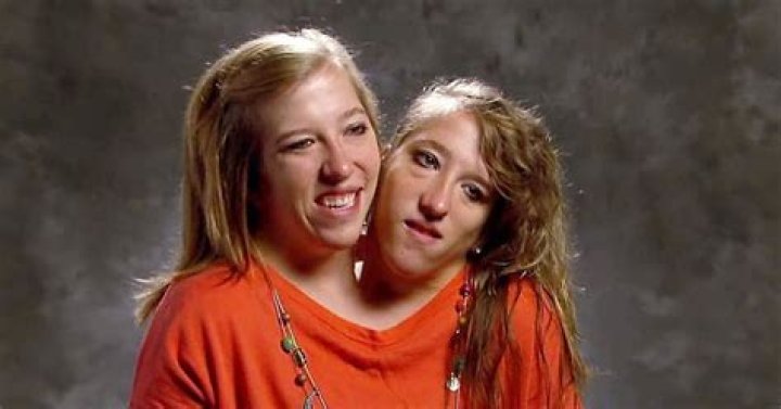 Conjoined Twins Ronnie and Donnie Galyon: A Remarkable Journey of Resilience and Love