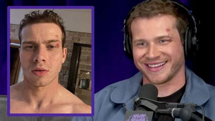 Does Oliver Stark Have a Birthmark on His Face? Unveiling the Truth